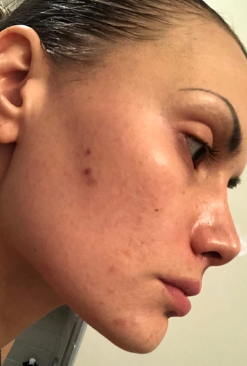 reviewer's skin before using the Differin gel