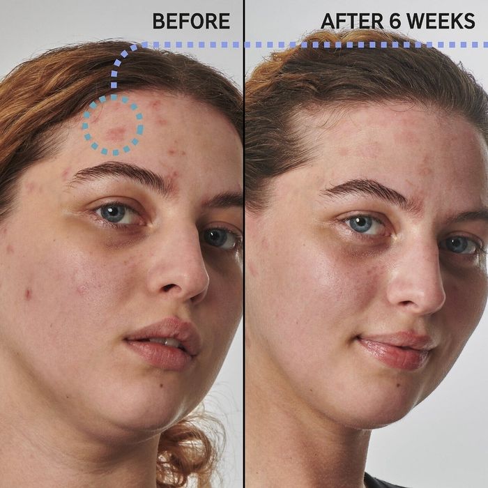 Before-and-after image of a model using the moisturizer, with a six-week gap between the photos.