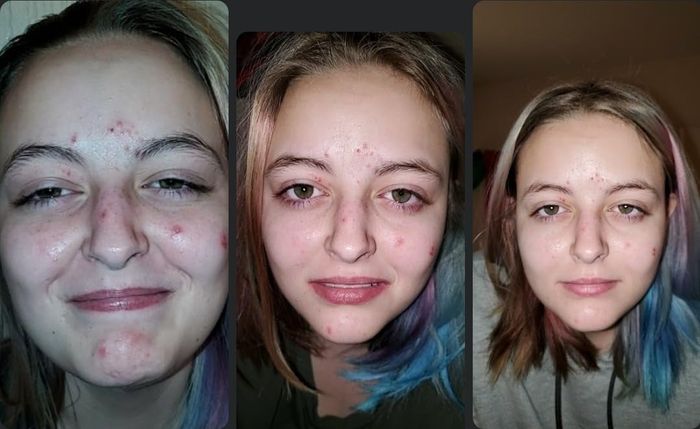 Reviewer's three facial progression photos showing reduced acne