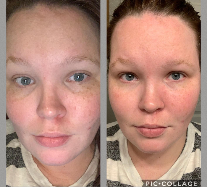 Before photo of a reviewer with deep, dark under-eye circles, followed by an after photo showing the same reviewer with visibly lighter under-eye skin.