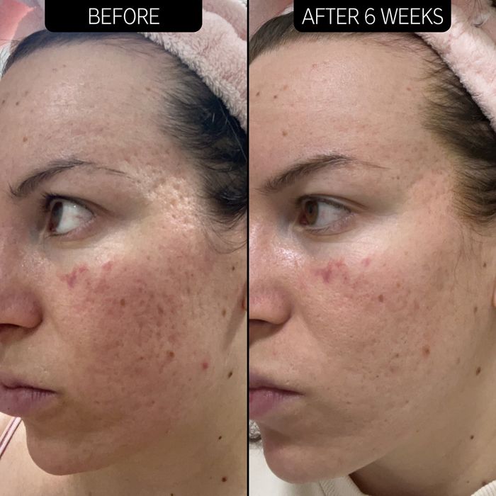 Before-and-after image of a model using the retinol serum, with a six-week gap between the photos.