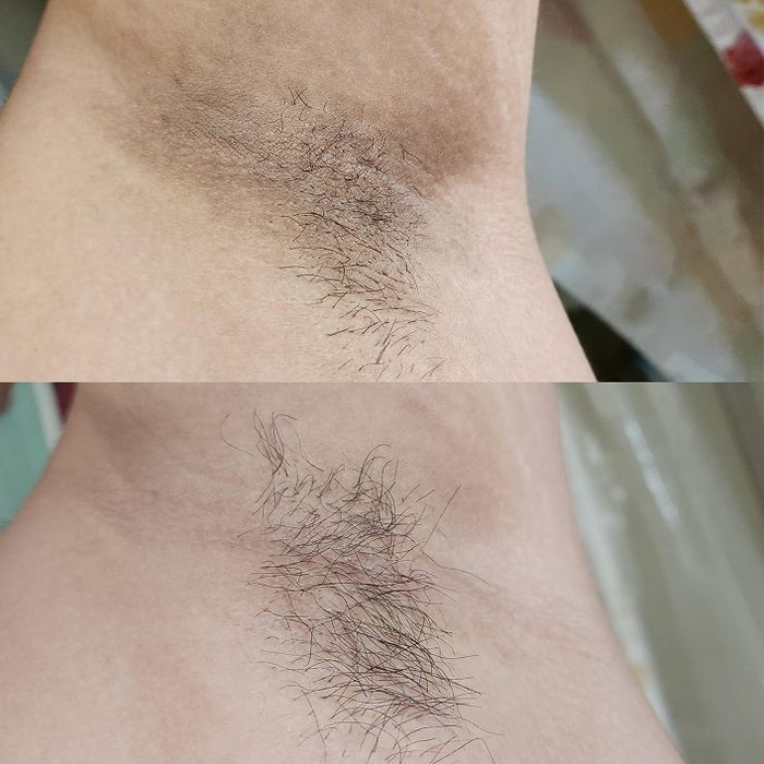 before and after photos showing a reviewer's underarm lightening from dark to bright