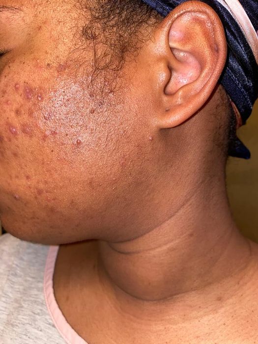 Reviewer's before photo showing uneven, rough skin in need of exfoliation.