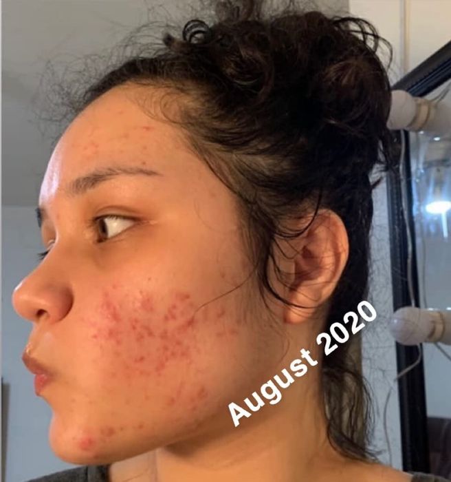 Reviewers showing their skin before using the exfoliant, with visible redness and acne
