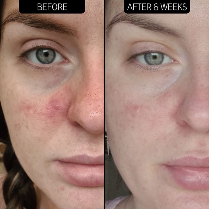 Before and after image of a model using the redness relief product, six weeks apart