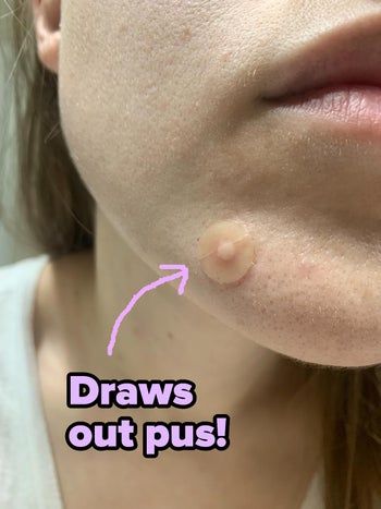 A reviewer with a skin patch and visible pus being drawn out