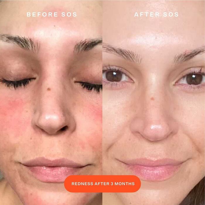 Model before and after using the spray; spray helped eliminate redness and gave the skin a smooth, even tone