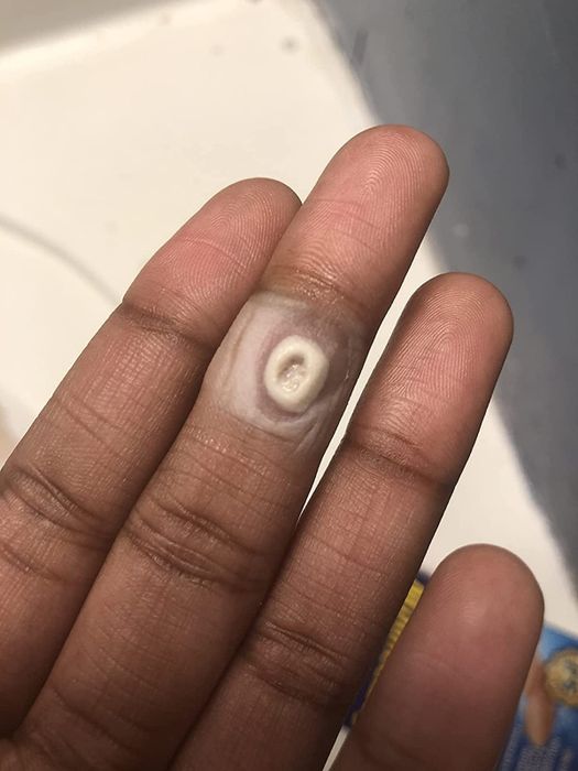 Image of a reviewer's hand with a wart on one of their fingers.