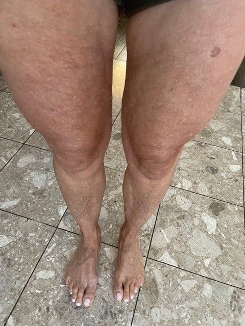 An after photo of the same reviewer, with their leg skin looking noticeably firmer and the cellulite virtually gone.