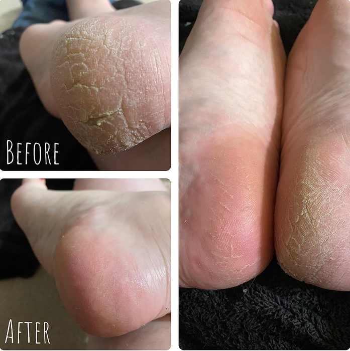 Before and after photos of a reviewer using the callus remover, showing remarkable improvement.