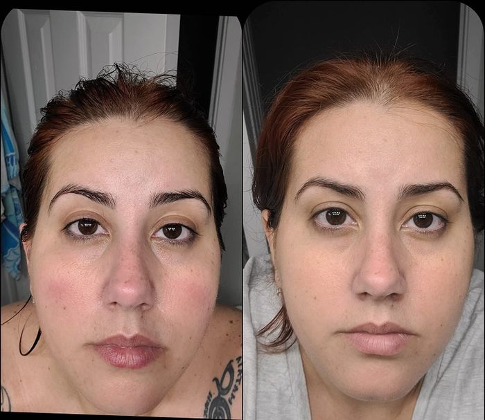 before and after images of the reviewer showing noticeable improvement with redness fading