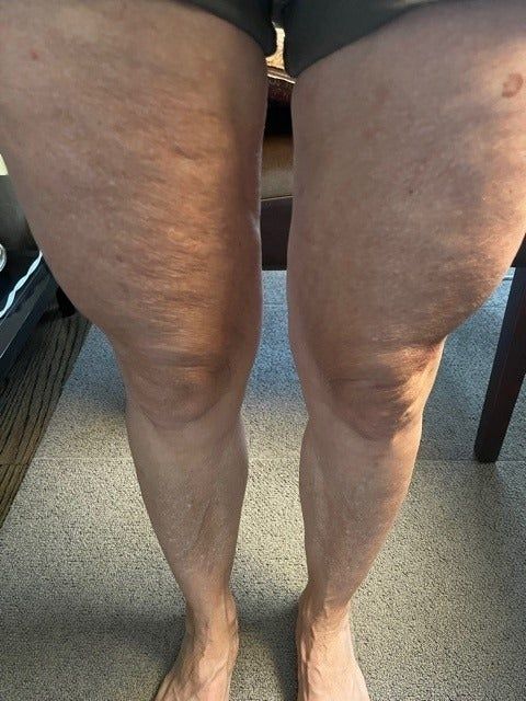 A before photo of a 60-year-old reviewer’s legs showing cellulite on their thighs.