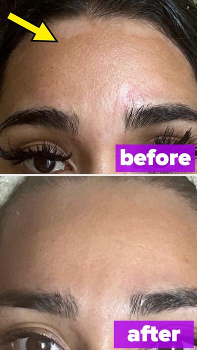 Two close-up photos focusing on a reviewer's forehead and eyebrows, highlighting changes in hair growth or cosmetic alterations, with no text included.