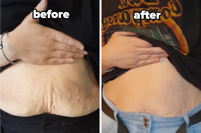 Before-and-after photo showing visible improvement in the appearance of the skin on the abdomen, highlighting the lotion's effectiveness.