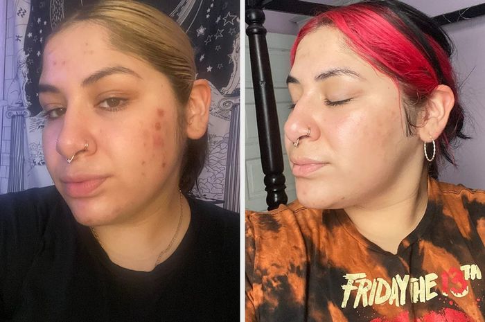 Before and after photos of a reviewer’s face, showing a bright and glowing complexion after using the vitamin C serum. The before photo features duller skin with acne.