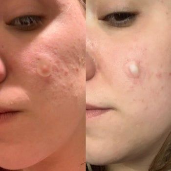Before-and-after photo of a reviewer using the Mighty Patches, showing noticeable improvement.