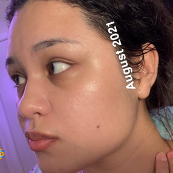 A reviewer’s smooth, clear skin after using the exfoliant consistently for a year.