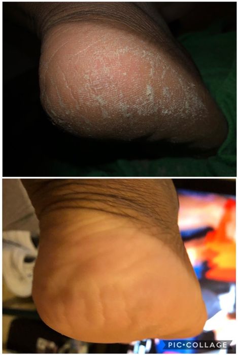 Top: heel with dry, cracked skin. Bottom: the same heel smooth and crack-free after using the callus remover gel