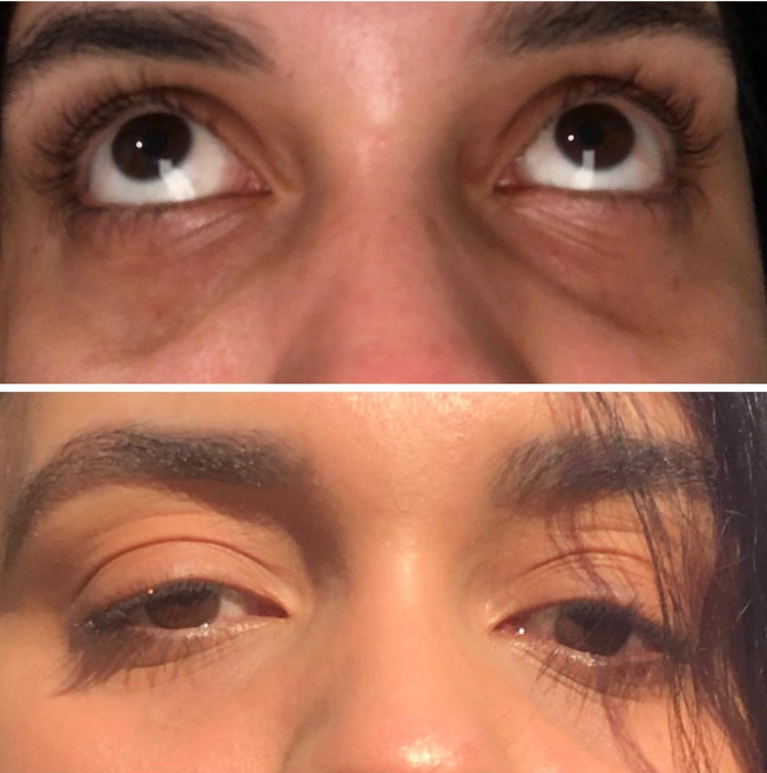 Reviewer with dark under-eye circles before using the eye stick and noticeably brighter, smoother under-eye skin after use