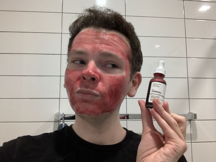 Mytour writer Daniel Boan after applying The Ordinary peeling solution.
