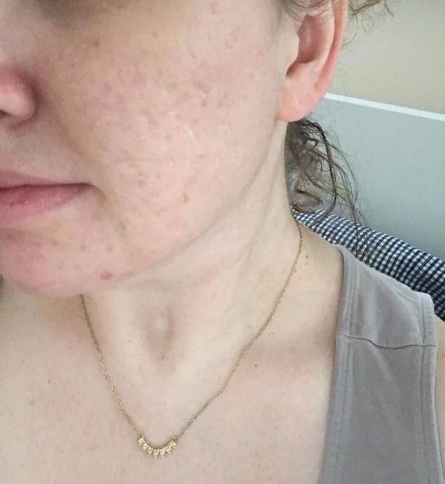 the same reviewer after consistently using the peel, showing a significant reduction in the pitting on their cheeks