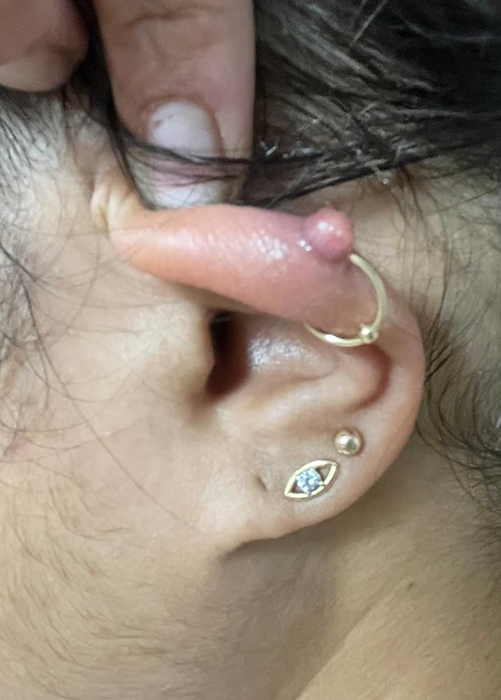 A reviewer's ear showing a keloid bump on their piercing.