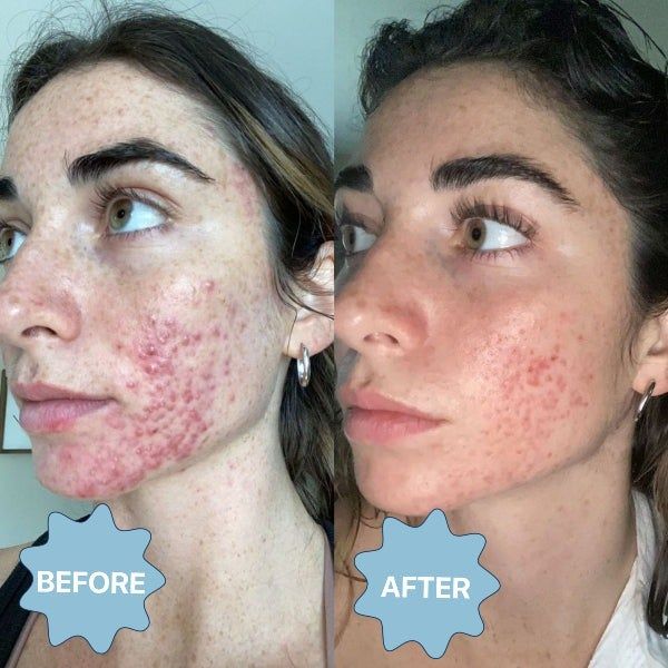 Side-by-side comparison of a person's face showing reduced acne after treatment.