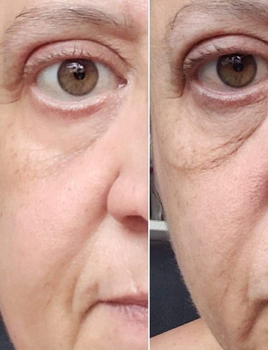 Before and after images of a reviewer showing their dark, saggy under-eyes transformed into smoother and brighter skin