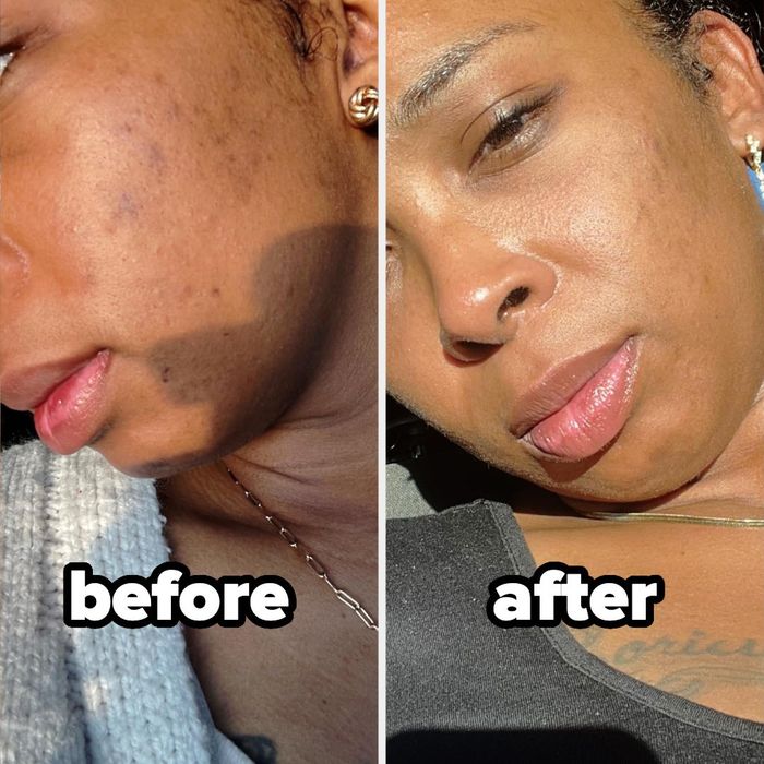 Before and after photos showing a reviewer's skin, visibly clearer and brighter after using the resurfacing pads.
