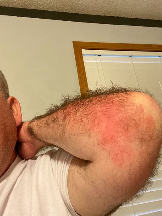 image showing a reviewer's elbow with a red rash