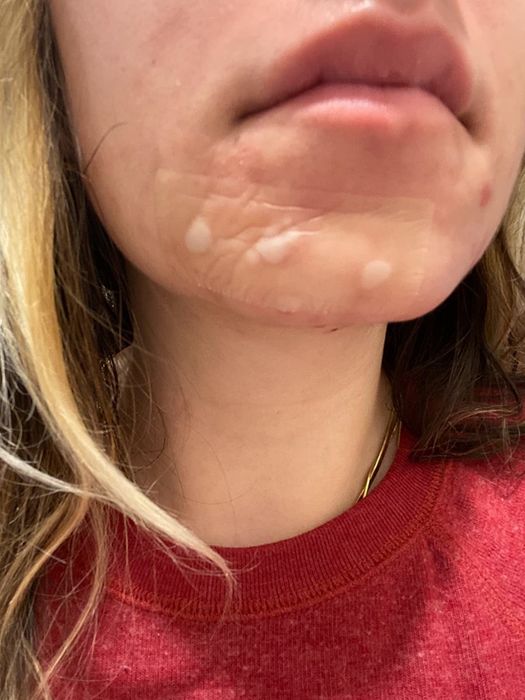 a reviewer applies one of the patches to her chin, effectively drawing out impurities from zits