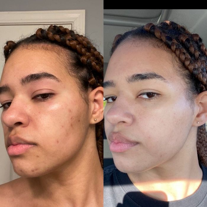 before and after photos of a reviewer showing facial acne improvement