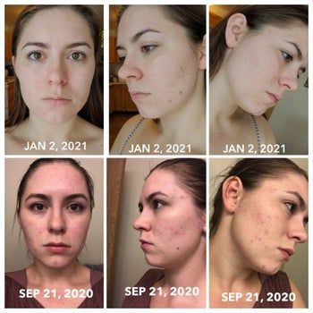 bottom right to top left: a series of before-and-after photos displaying a reviewer’s acne-covered face on Sept. 21 and a significantly clearer complexion by Jan. 2 after months of using the treatment