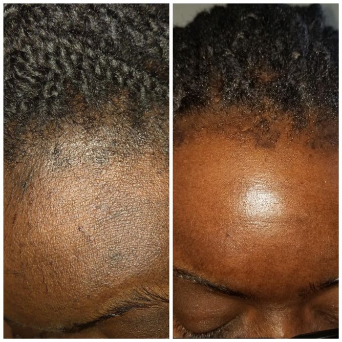 before and after images of a reviewer's forehead showing uneven tone and dark spots (left) compared to a more radiant and even-toned forehead (right)