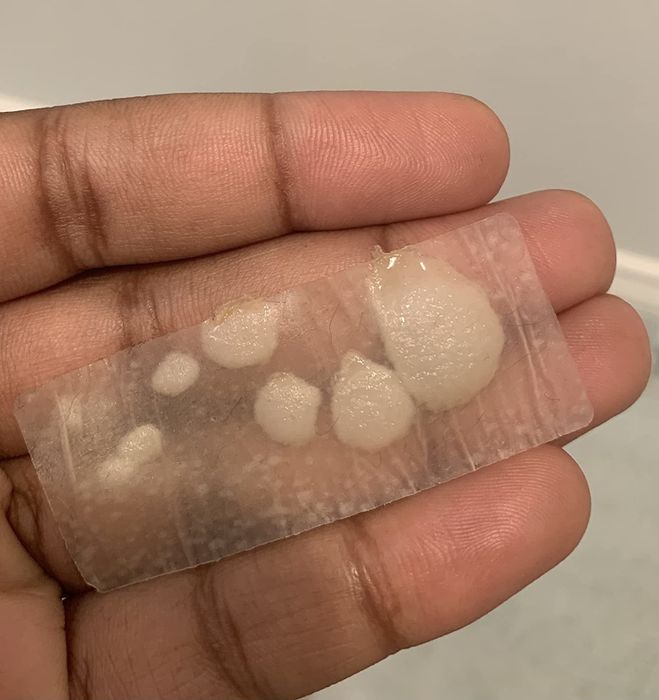 a hand holds one of the patches, now covered in large pus-filled circles extracted from shoulder zits