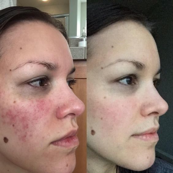 on the left, a reviewer’s face with acne and red spots; on the right, the same reviewer’s clear, blemish-free skin after using CeraVe Moisturizing Cream