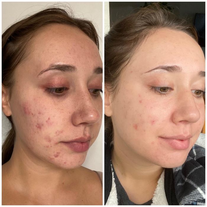 close-up before-and-after photos of another reviewer showing acne marks on their cheek, followed by the same area with fewer marks a few weeks later