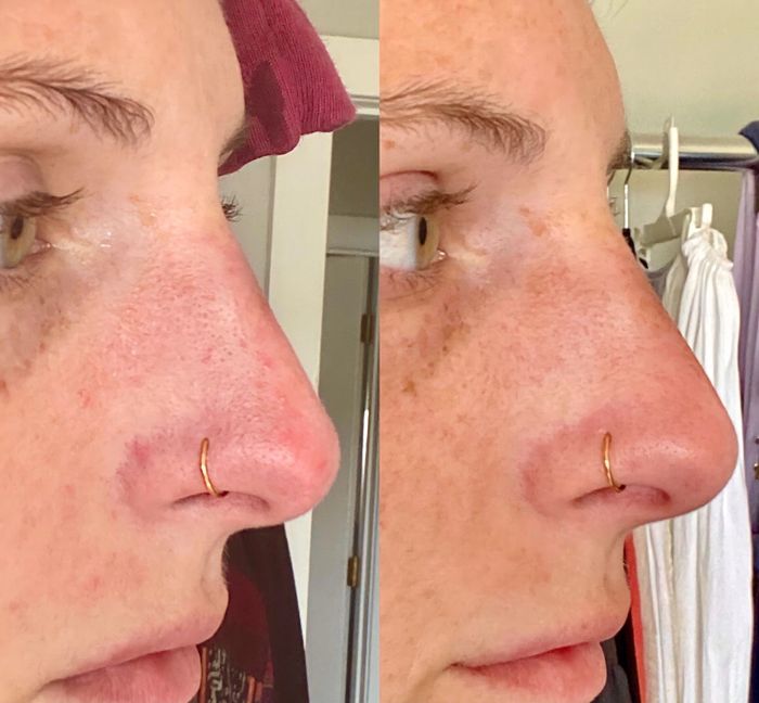 before and after photos of the side of a reviewer's nose displaying red spots (left) versus the same area with significantly reduced redness (right)