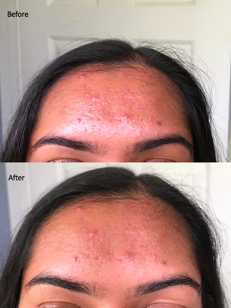 a customer review photo showcases the noticeable difference on their forehead before and after using the blotting papers