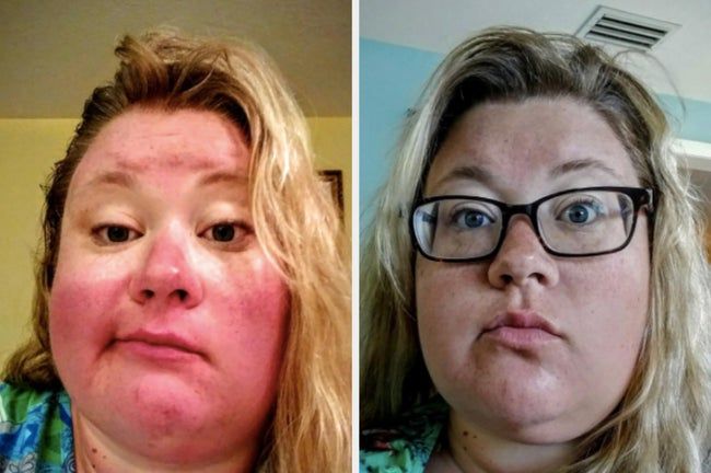 a reviewer's photo showing a severe sunburn on their face, followed by the same reviewer with makeup applied, appearing slightly tanned instead of sunburned