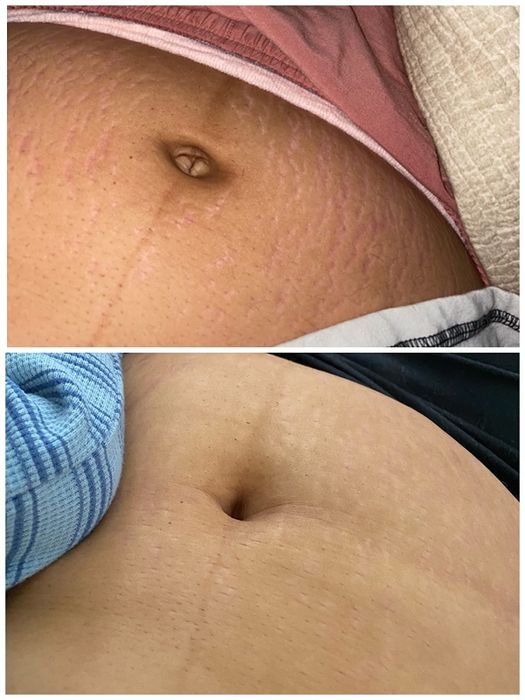 top to bottom: a stomach with visible stretch marks and the same stomach showing fading stretch marks after consistent use of Bio-Oil