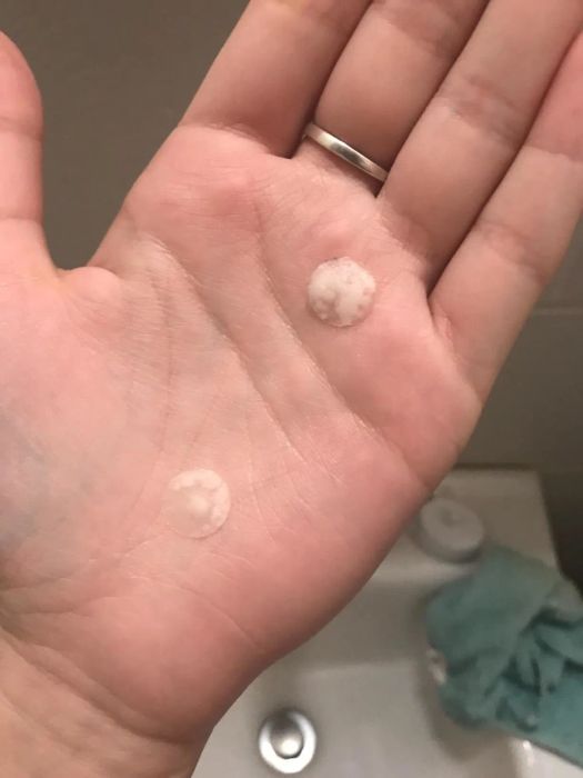Two smaller circular pimple patches with visible absorbed pus
