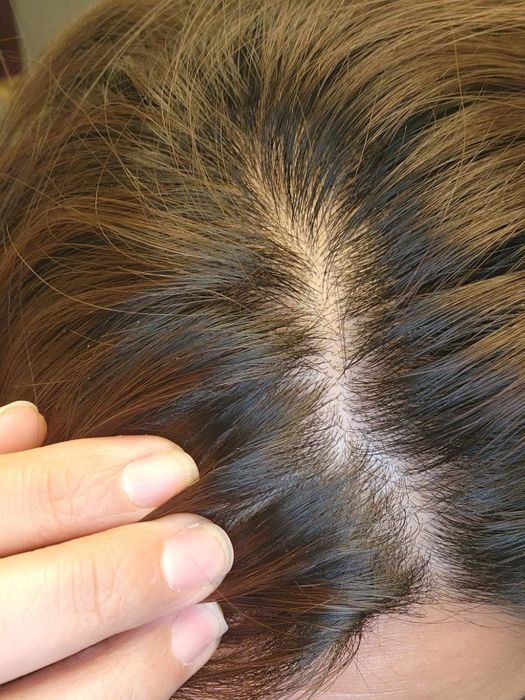 The reviewer’s scalp after using the shampoo.