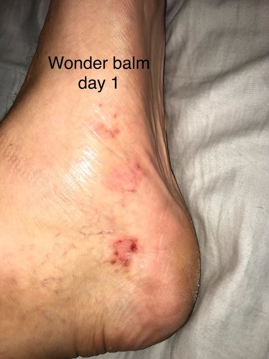 Image showing a reviewer's foot after one application of the balm