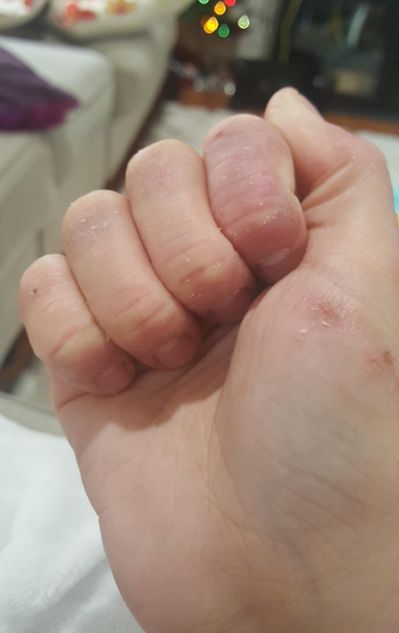 The same reviewer’s hand after treatment, now appearing more moisturized, less red, less cracked, and visibly calmer.