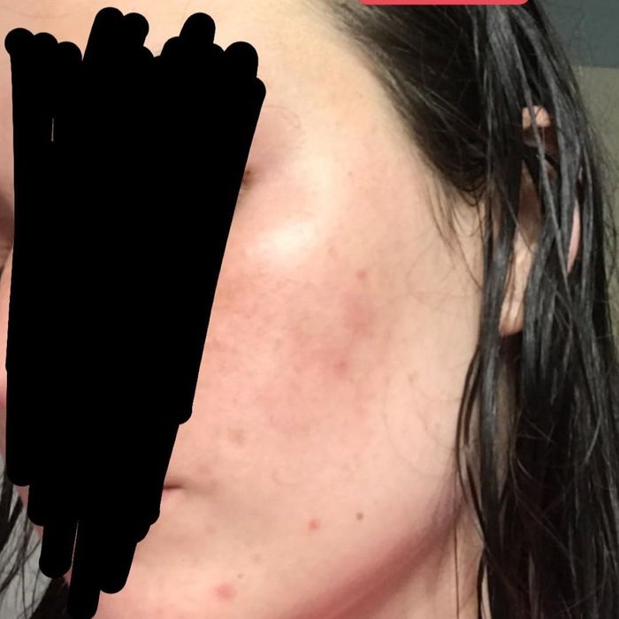 The same reviewer after using the serum, showing a noticeable reduction in acne and redness.