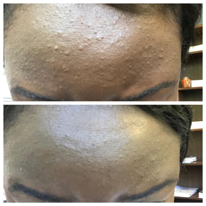 A before-and-after comparison showing a reviewer's forehead with significantly reduced cystic bumps after use.