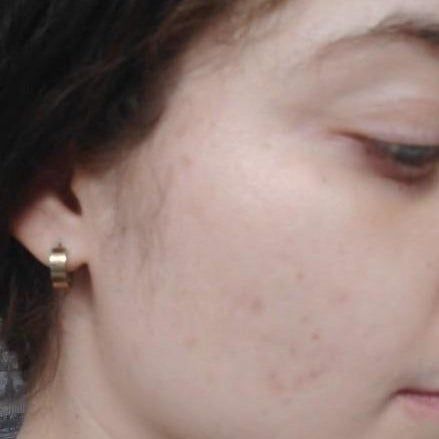 The same reviewer showing clear skin with no active acne and faded marks.