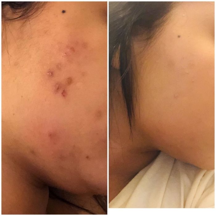 A reviewer's before-and-after photos showing cleared-up cheek acne.