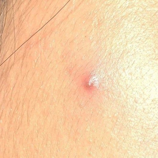 A reviewer's inflamed pimple, appearing as a whitehead.